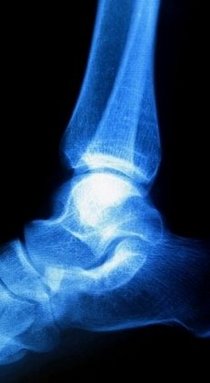 Canton and Ypsilanti Podiatrist | Canton and Ypsilanti Haglund's Deformity | MI | Advanced Family Foot & Ankle |