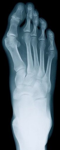 Canton and Ypsilanti Podiatrist | Canton and Ypsilanti Rheumatoid Arthritis | MI | Advanced Family Foot & Ankle |